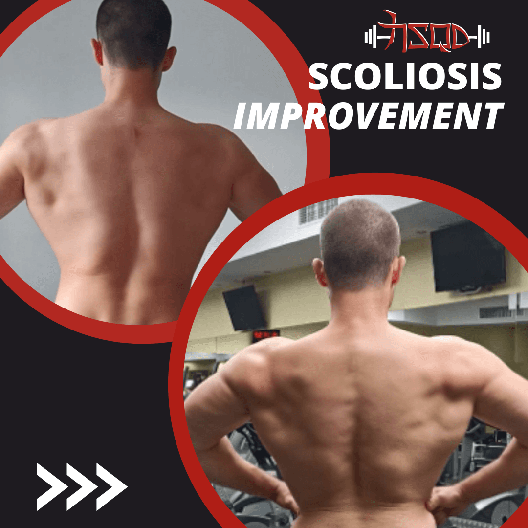 Клиент Преслав — подобрение при сколиоза чрез рехабилитационен коучинг в Strength Squad